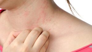 Eczema Skin On Neck